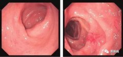 萎縮性胃炎不可怕，只要