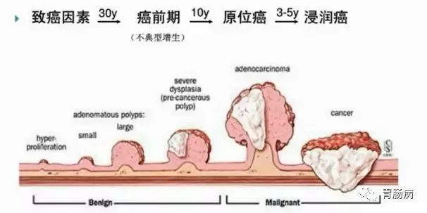 體檢查出腸息肉一定要切除！ 95%腸癌由它演變而來
