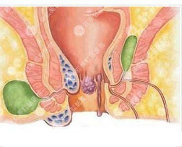 南寧哪個(gè)醫(yī)院可以做肛周膿腫？